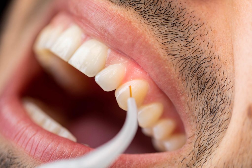 wisdom teeth extraction | Studio Smiles wisdom teeth extraction