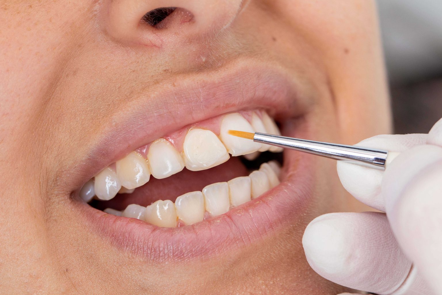 Dental Veneers Melbourne Veneers Cost Melbourne VIC