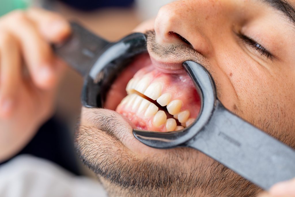 Studio Smile Treatment | Studio Smiles Studio Smile Treatment