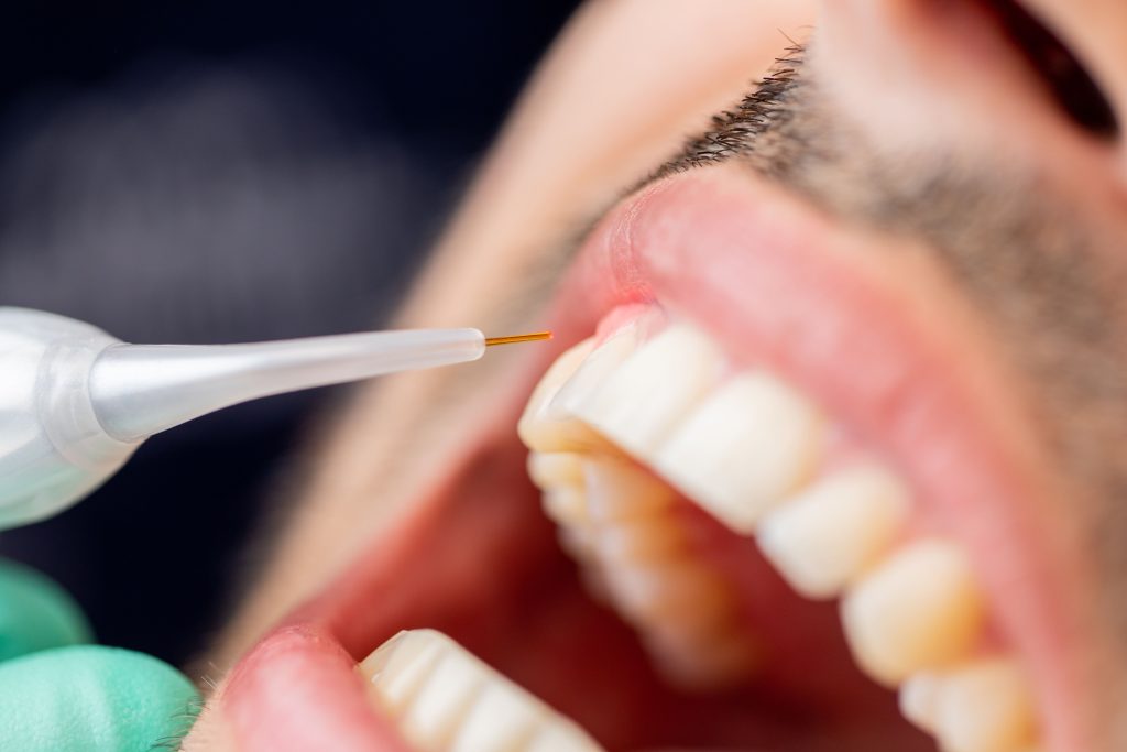 anesthesia | Studio Smiles anesthesia