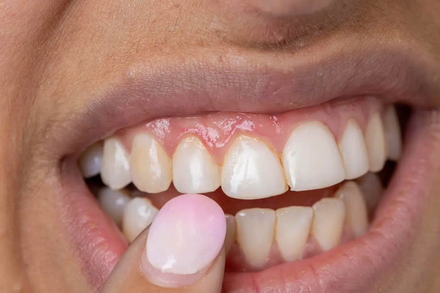 gaps between | Studio Smiles gaps between