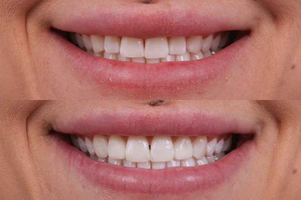 Composite Veneers Before After - Front | Studio Smiles Composite Veneers Before After - Front