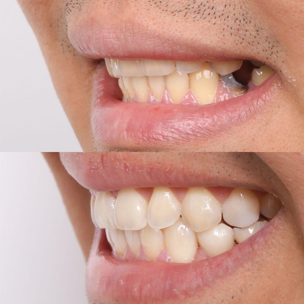 Kang-Side-Before-and-After-Combined-1-1024x1024 | Studio Smiles Kang-Side-Before-and-After-Combined-1-1024x1024
