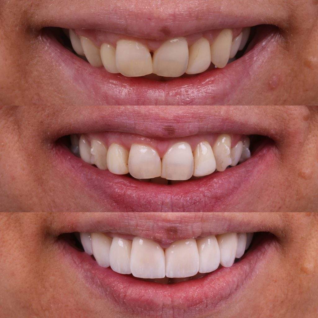 Lucy-Before-and-After-Smile