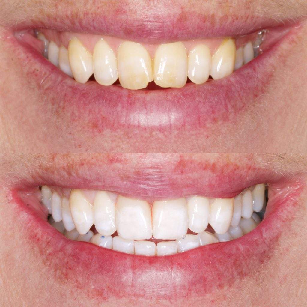 Lucy-Before-and-After-Smile | Studio Smiles Lucy-Before-and-After-Smile