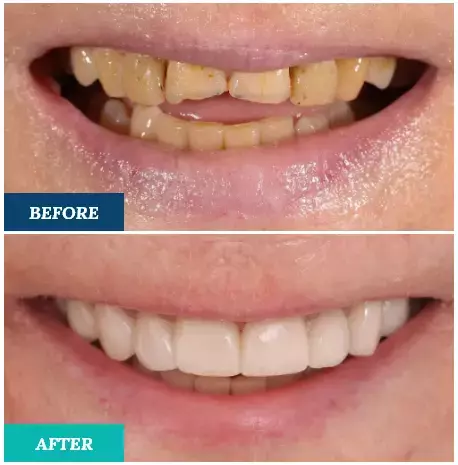 all-on-4-before-after-first-img | Studio Smiles all-on-4-before-after-first-img
